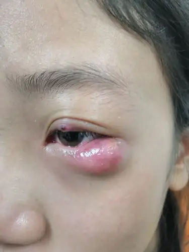 睑腺炎(俗称:麦粒肿,中医名:针眼)的个人经验治疗