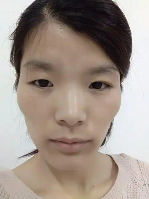觉得自己的脸型不好看,颧骨那块好高,呜呜呜 22岁的时候矫正牙齿拔了