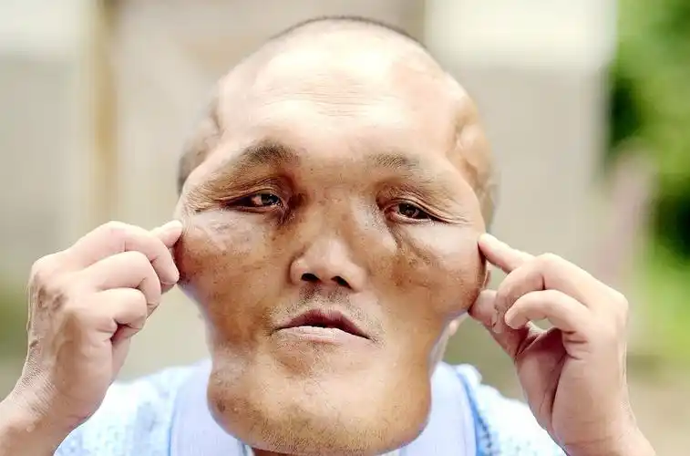 相貌异于常人的老夏在当地是个"名人",他头大如盆,体量超过常人两倍