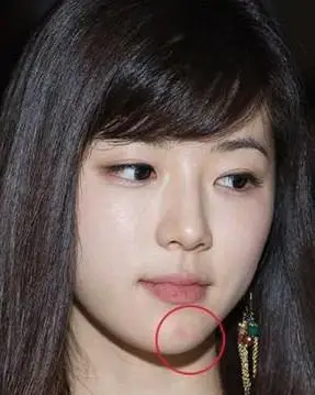 答:下巴长痘一般表示体内激素失调,周期失衡.