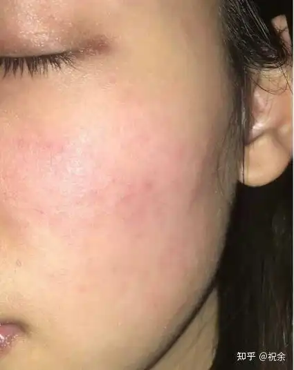 脸上有红血丝应该怎么做? - 知乎
