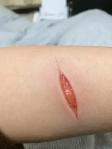 2,3天前刮眉刀划的,请问医生需要缝针吗