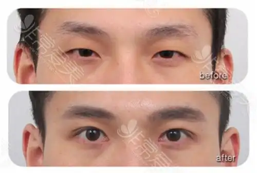 男性双眼皮手术前后对比