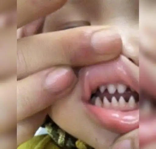宝宝一张口众人诧异牙齿像鲨鱼牙爸爸妈妈心慌着急