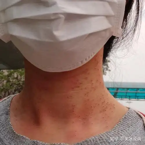 脖子为什么长疣子