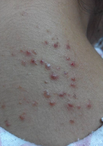 皮肤热毒图片 (30)_有来医生