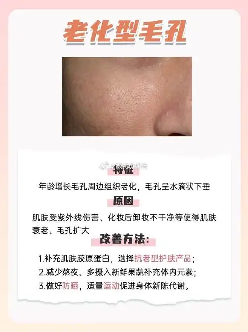 不迷糊了731分钟简单判断毛孔粗大原因90