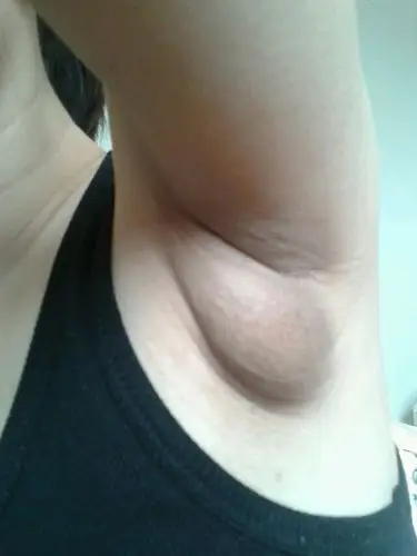 怀孕后双侧腋下都长了鸡蛋大小的疙瘩,而且皮肤都变黑了,出汗厉害平时