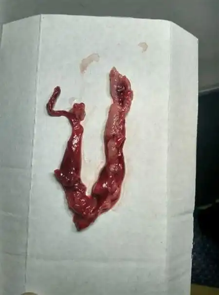 六个月做引产一共需要几天