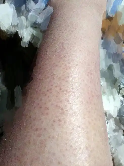 我妹妹皮肤特别干燥,容易起皮,而且冬天就跟蛇皮一样.