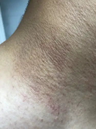 20 前几天脖子很痒,当时也没在意,痒痒就挠,当时好像是红包,现在背缮