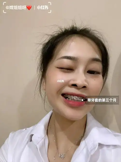 带牙套的第三个月