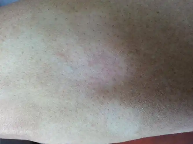 局部萎缩. - 皮肤及性传播疾病讨论版 - 爱爱医医学论坛