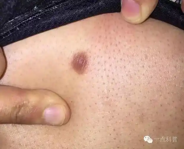 会癌变吗?_皮肤