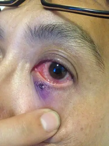 老爸眼睛出现了这种情况,本来上面有一颗一颗白白的小点,第二天就像