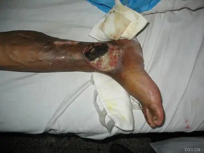 患者,53岁,23年前出现双下肢静脉曲张,皮肤色泽改变,溃疡,在当地医院