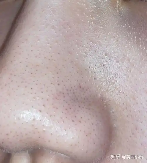 同事一个个好精致!而我鼻子黑头超严重,感觉鼻子像塞满了芝麻!求助乳