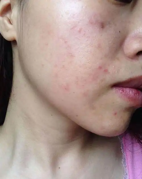 朵嘉浓玫玫敏感皮肤总是发烫发痒泛红该怎么办