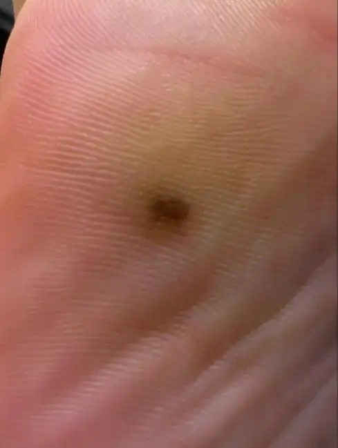 如图脚底黑点是什么?