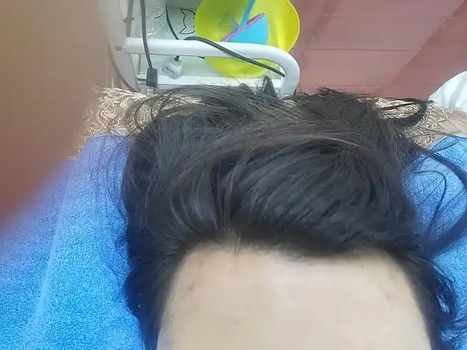 我是典型的m型额头丑到爆特别怕刮风一直想做发际线终_圈子-新氧美容