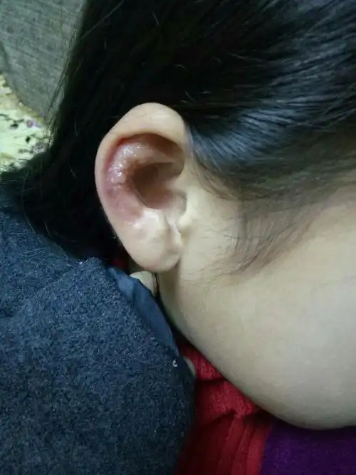 宝宝耳朵轮廓长水泡怎么回事?刚发现!