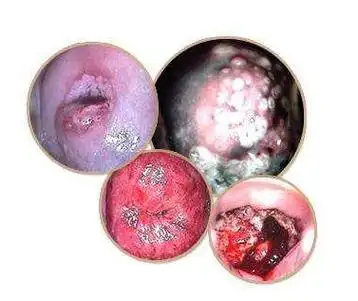 霉菌性阴道炎的偏方