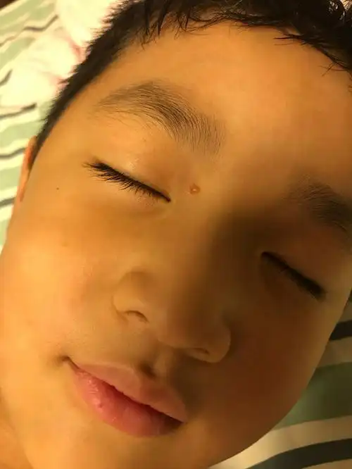 好好的眼睛旁边长个肉疙瘩不知道是什么