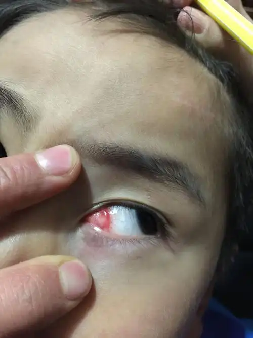 小孩眼睛这么红是什么原因,还老眨眼