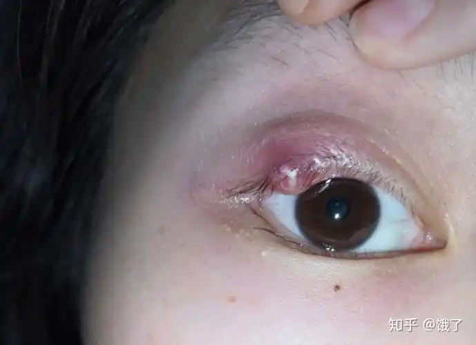 上眼皮麦粒肿了,还挺大,出现了脓头,该怎么办啊?求大神们分享 - 知乎
