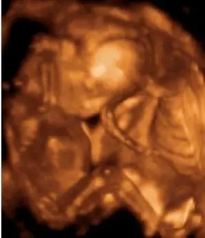 怀孕第18周胎儿图