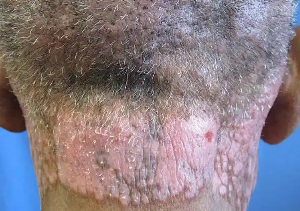 艾滋病初期皮肤的表现,一旦出现,立即就医!