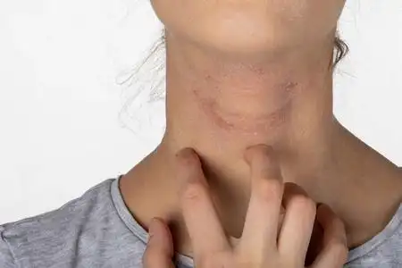 手指皮炎症状女孩颈部皮肤过敏发痒.