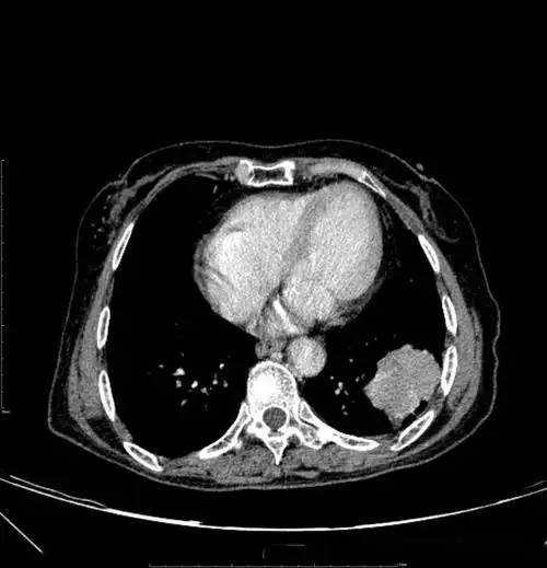 胸部ct平扫示左下肺占位肺癌