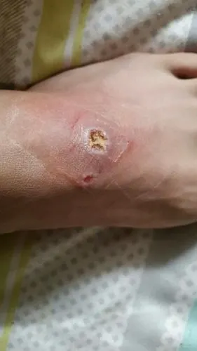 前两天脚被烫伤了,很快结痂了,但是因为一些原因,要走很长的路,脚与