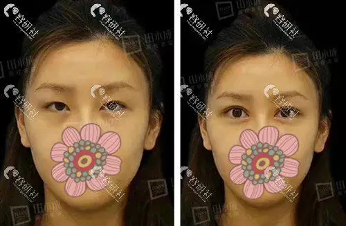 北京田永成双眼皮修复前后对比图 图源www.rongyanshe.com