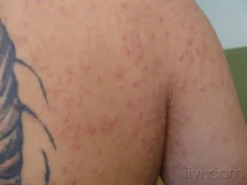 过敏性皮炎湿疹