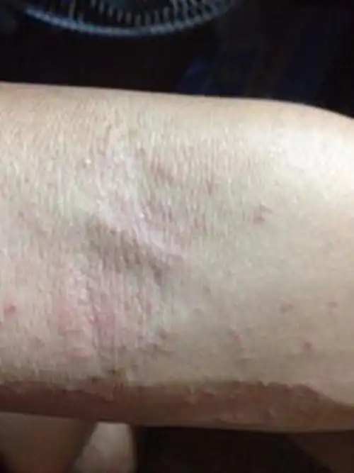 孕妇疥疮初期腹部皮肤症状图片