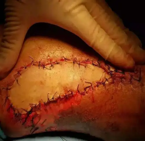 医院故事工地受伤险截肢9个诊断多次手术保腿成功