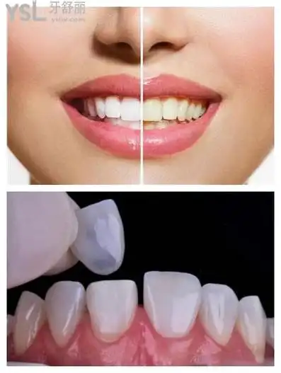 2021全新的牙齿美白贴面价格表公布,获取美加,emax牙贴面分别多少钱_