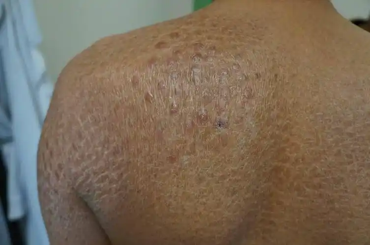 鱼鳞病可见皮肤干燥,伴有鱼鳞样或蛇皮样脱屑,不会自行消退