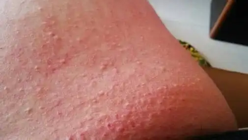 皮肤瘙痒起红疙瘩图片皮肤瘙痒是什么原因用什么药治疗