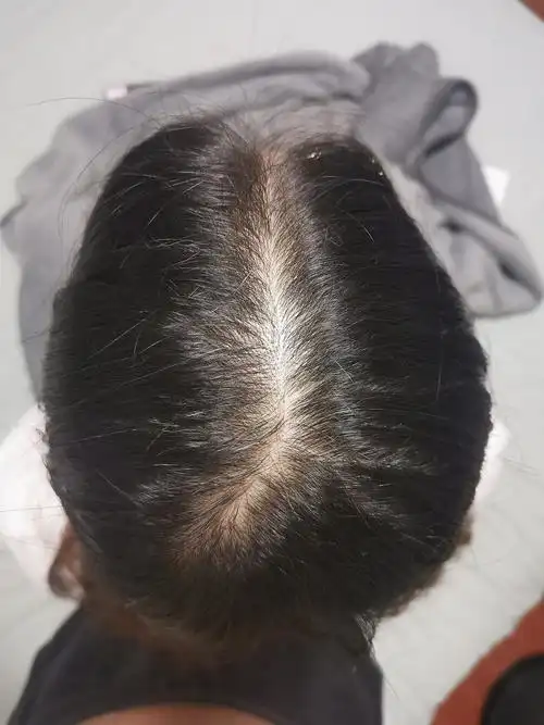 我这个在女性脱发里应该算严重的了吧