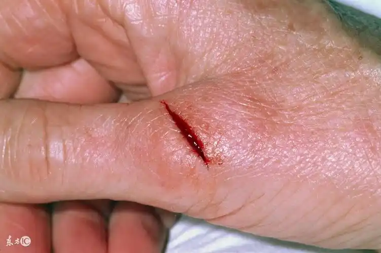 感染破伤风死亡率比癌症还高 哪些伤口需要打破伤风针?