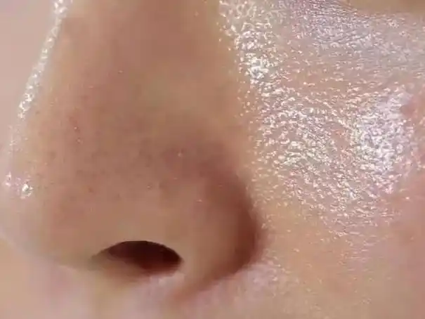 青春期体内激素分泌旺盛,皮脂腺活力旺盛,分泌油脂多,常有皮肤纹理粗