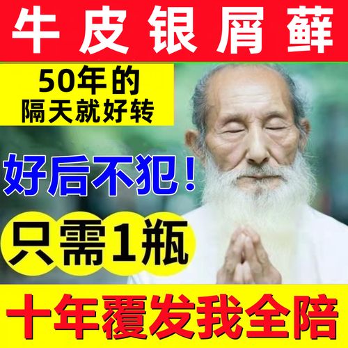 治疗牛皮癣廯银屑病皮肤瘙痒抑菌湿疹止痒去根除股体藓专用癣药膏