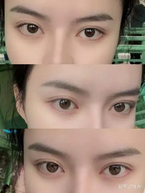 成都双眼皮蓉雅高标准—成都双眼皮手术 成都-完美整形