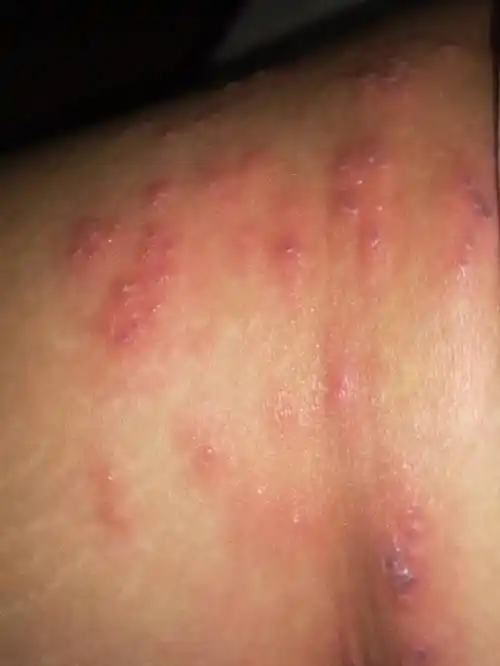 大腿内侧起红疹是什么原因