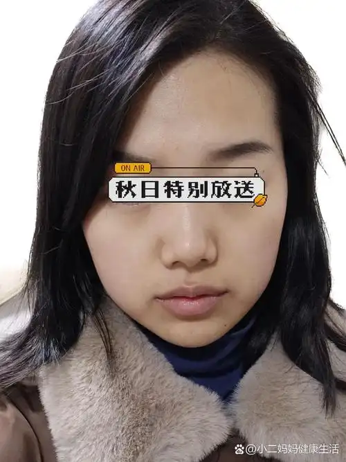 拔牙后遗症:脸垮,瘪嘴,面中凹陷,皮肤下垂 图234现在 图567是2019年