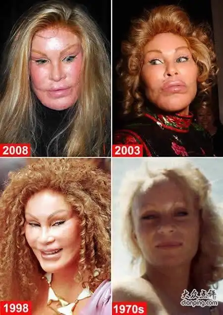 盘点全球最惨不忍睹的整容失败案例