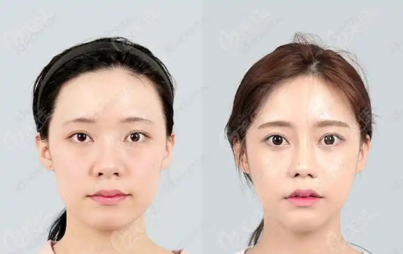 韩国id整形医院小翘鼻鼻综合前后对比照